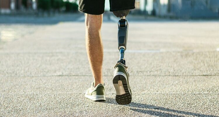Misconceptions About Living Life With a Prosthetic