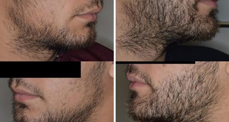 Beard Transplants in the Modern Age