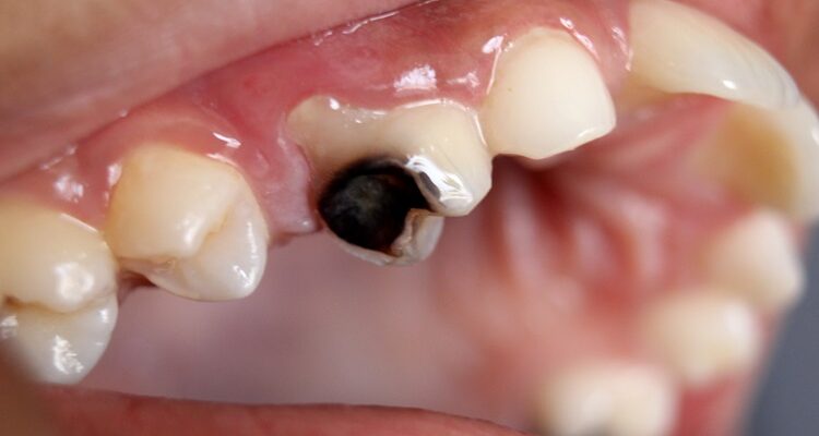 How Tooth Decay Can Be Cured